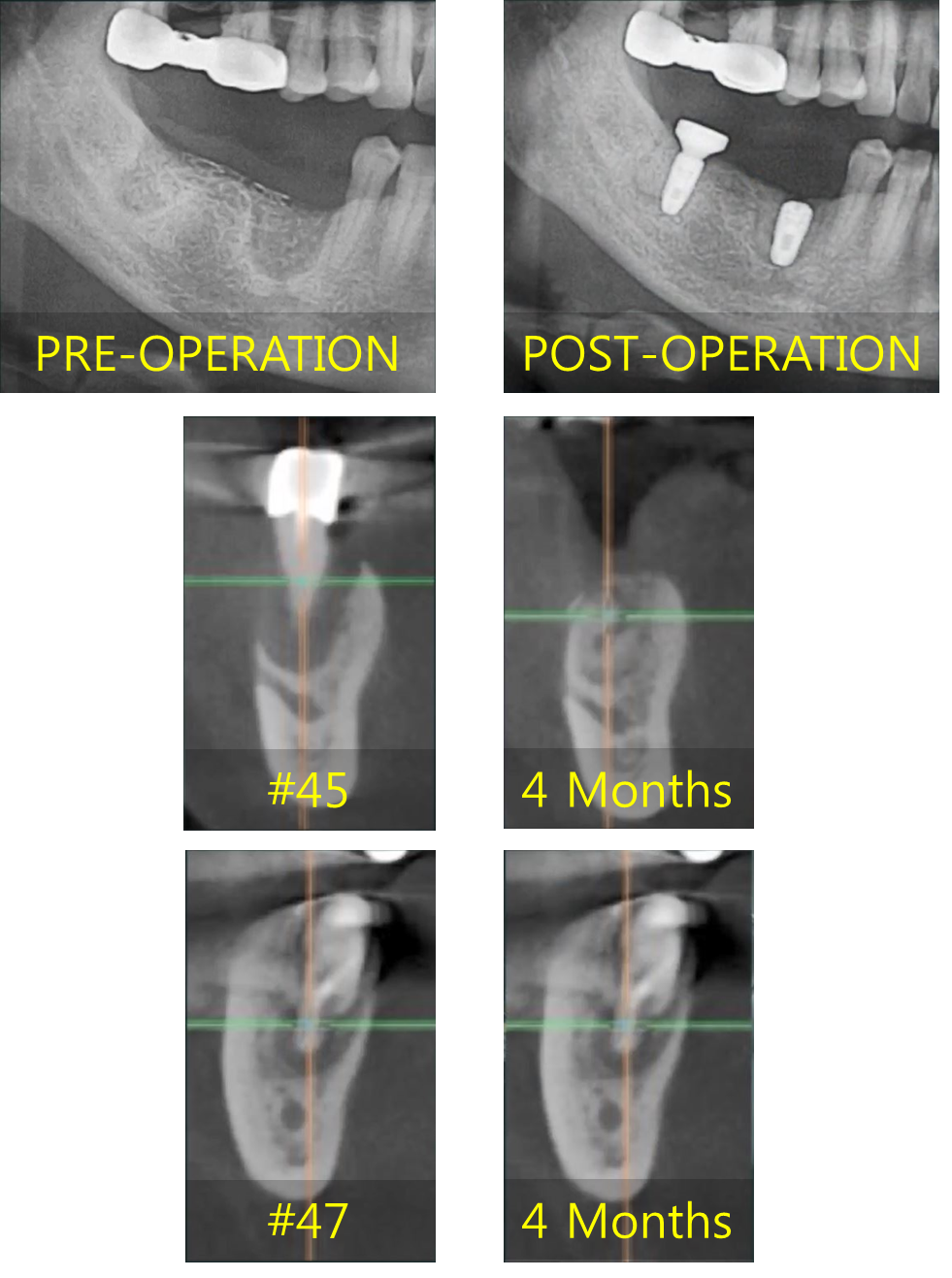 Socket bone graft and staged implant placement.png