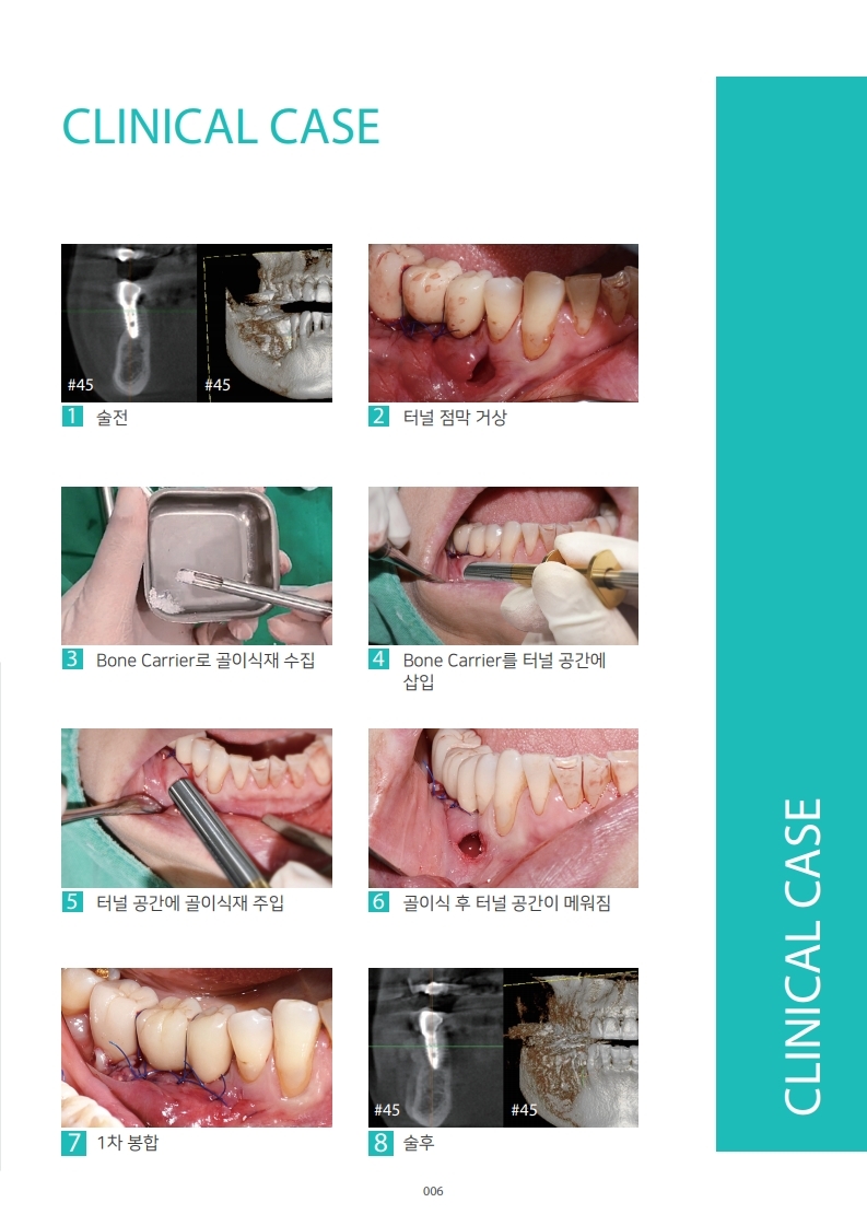 InnoGenic™ Bone Carrier_Kor.pdf_page_6.jpg